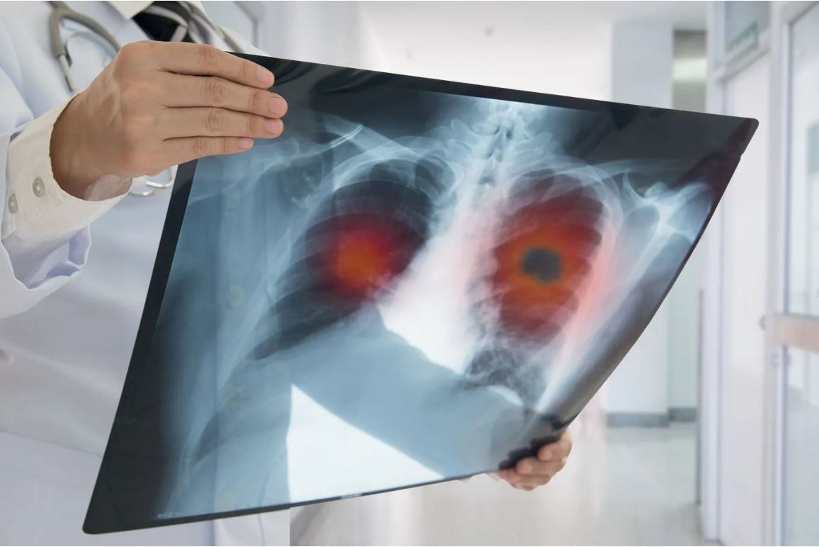 Co-Diagnostics receives grant for new tuberculosis test