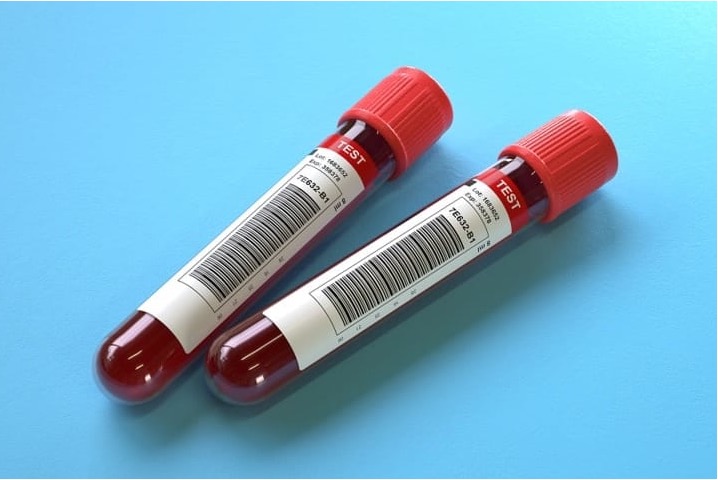 Study shows a frontline Alzheimers blood test could be as accurate as spinal fluid exams
